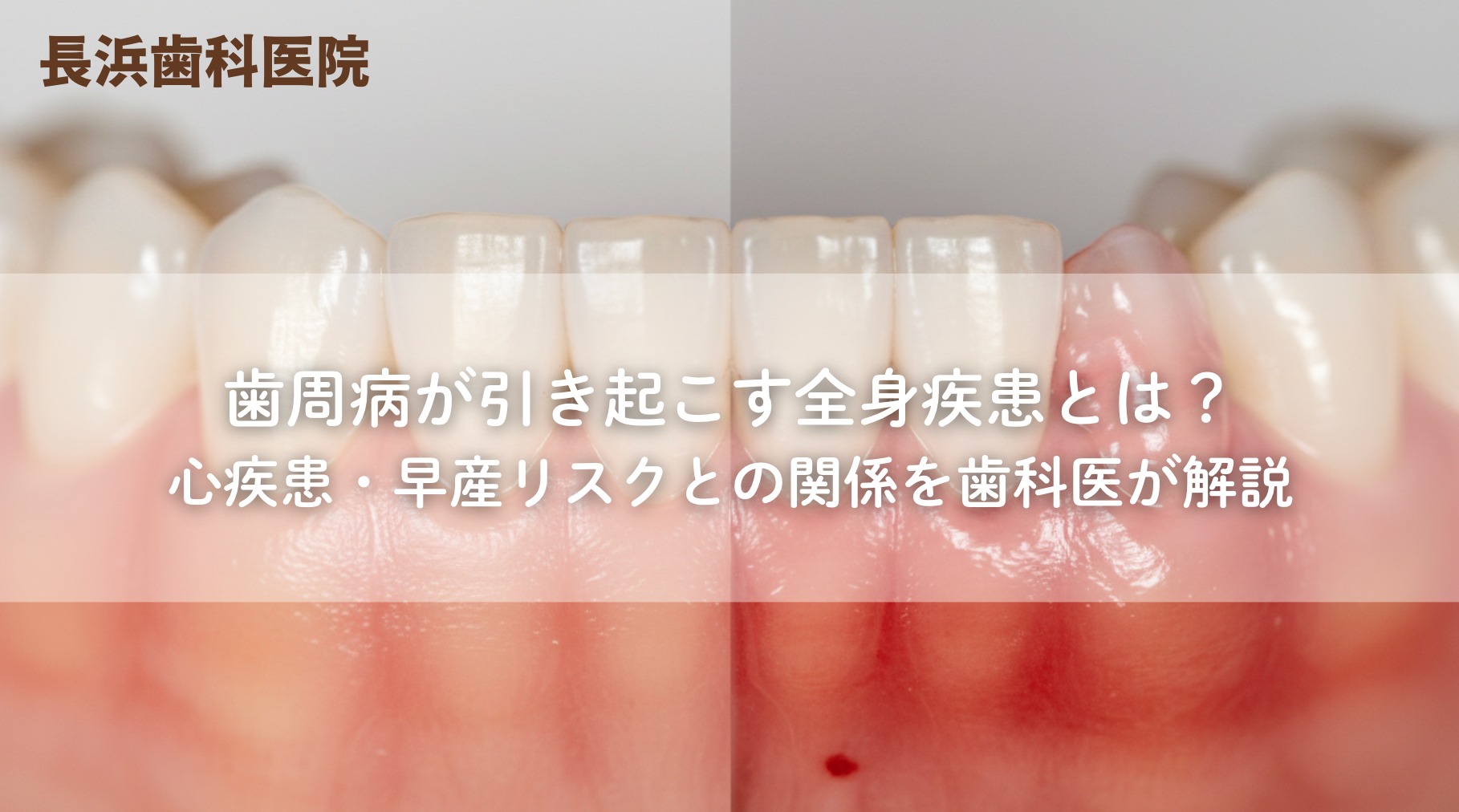 歯周病が引き起こす全身疾患とは?心疾患・早産リスクとの関係を歯科医が解説
