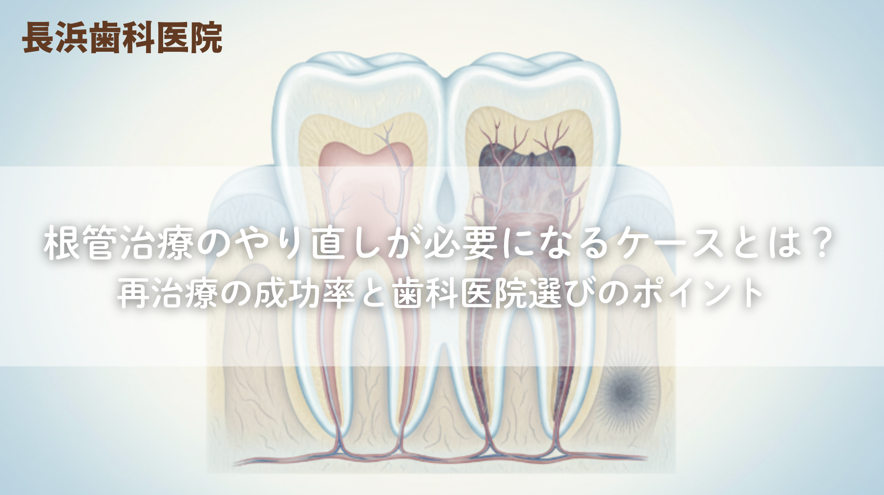根管治療のやり直しが必要になるケースとは?再治療の成功率と歯科医院選びのポイント