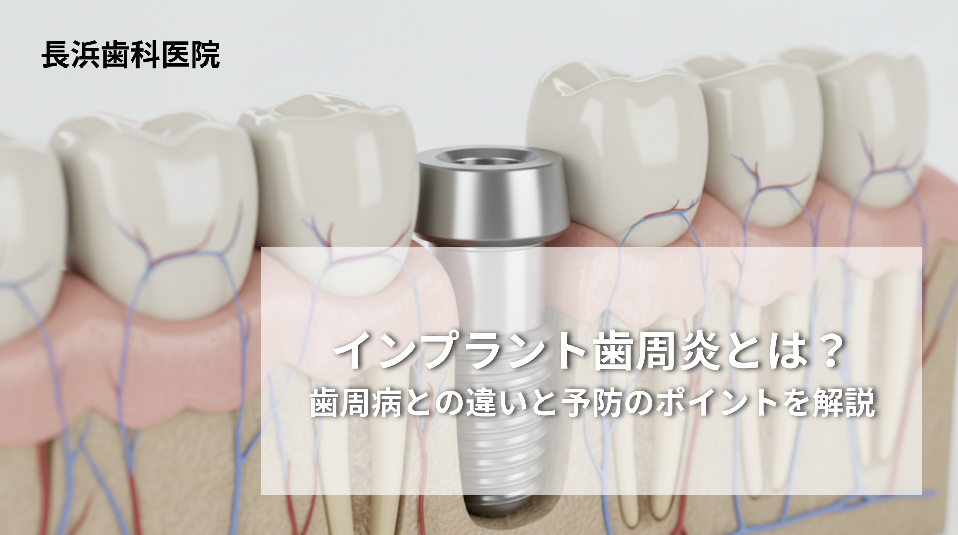 インプラント歯周炎とは？歯周病との違いと予防のポイントを解説